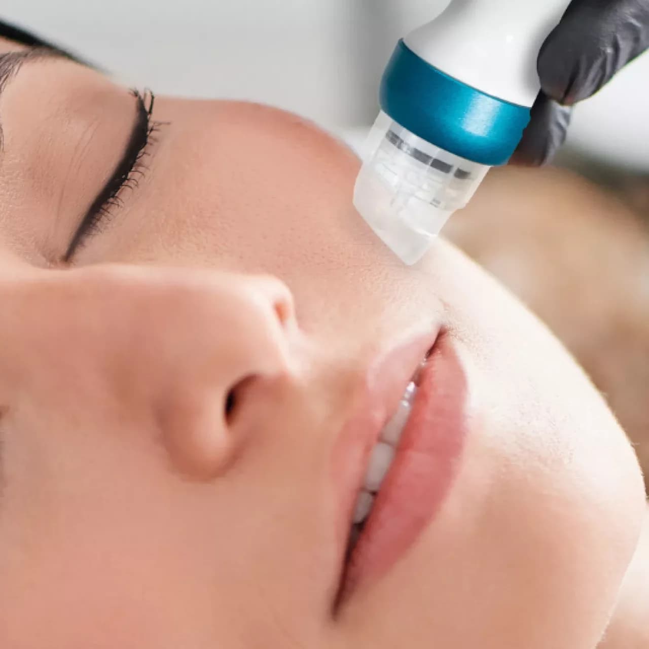 Hydro Microdermabrasion